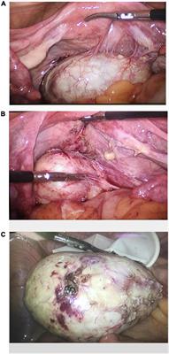 Mature cystic extragonadal teratoma in Douglas’ pouch: Case report and literature review